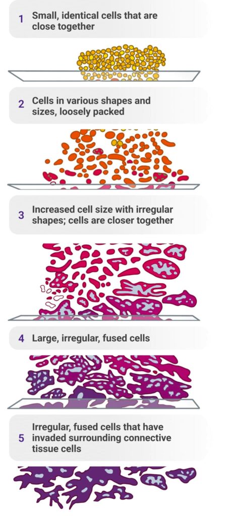 Drawn diagram showing normal and abnormal cells according to Gleason scoring.