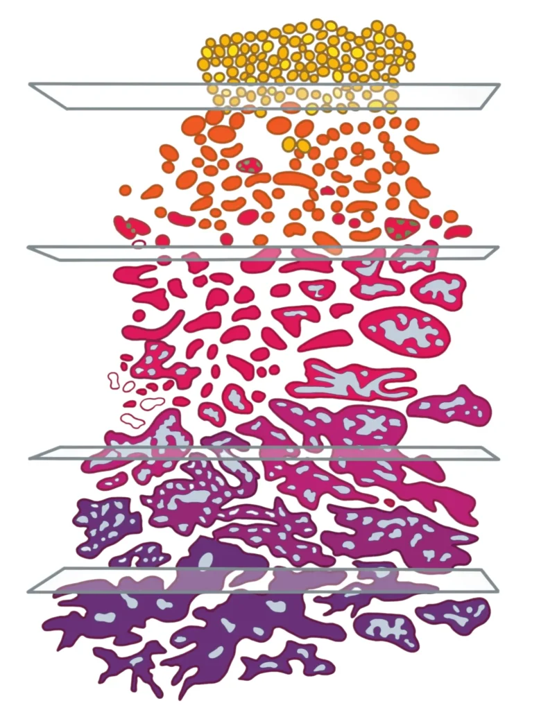 Drawn diagram showing normal and abnormal cells according to Gleason scoring.